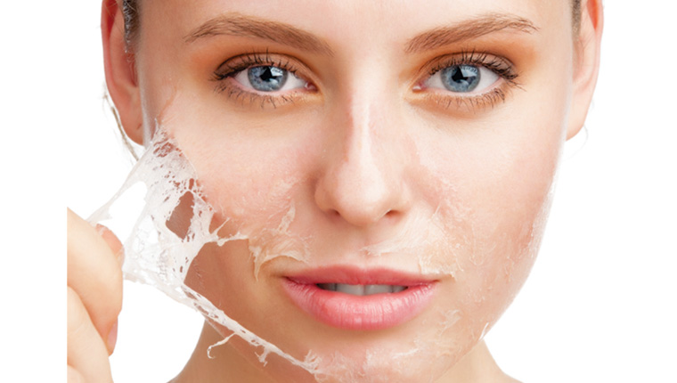 What is Chemical Peeling