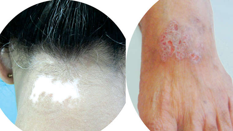 Laser and Lights for Vitiligo, Psoriasis