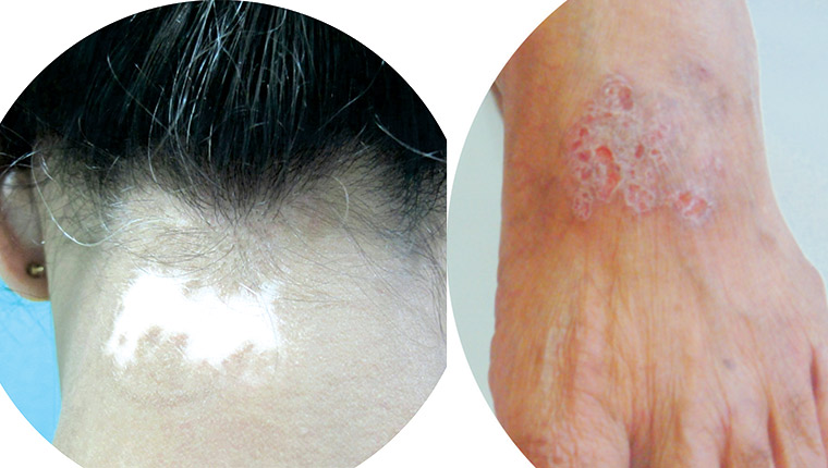 Laser and Lights for Vitiligo, Psoriasis