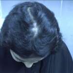 Hair PRP Treatment in Mumbai