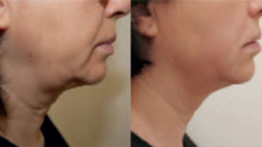 Face and body contouring