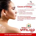 vitiligo