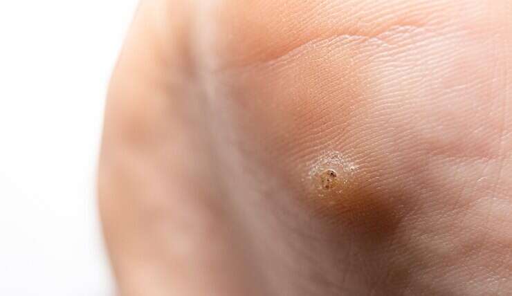 Viral Warts