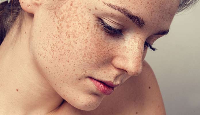 Melasma Treatment in Mumbai