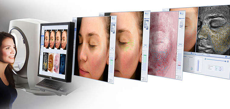3D Imaging Skin Analysis