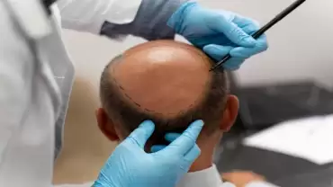 What to Expect from FUE Hair Transplant & How It Works