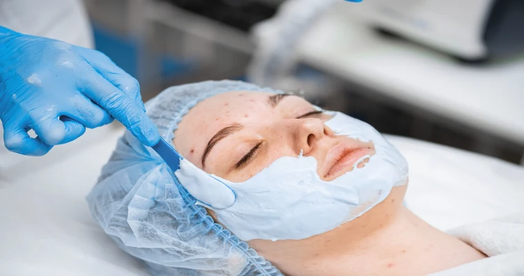 Chemical Peels for Acne to Achieve Clear & Radiant Skin