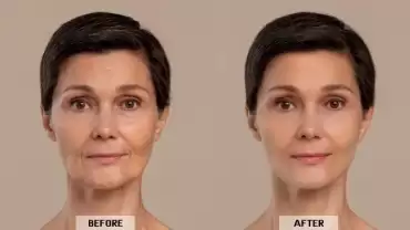 Botox Treatment for Aging: How It Works and Why It’s a Popular Choice