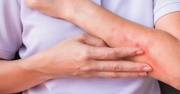 Common Skin Allergy Triggers and How to Avoid Them