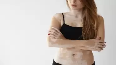 Vitiligo Treatment in Mumbai: What Skin Specialists Want You to Know