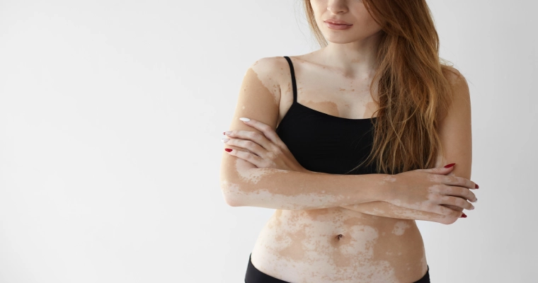 Vitiligo Treatment in Mumbai: What Skin Specialists Want You to Know