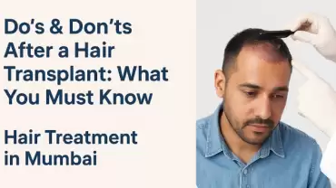 Do’s & Don’ts After a Hair Transplant: What You Must Know
